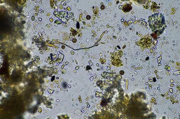 Overview of Pityriasis Lichenoides Chronica