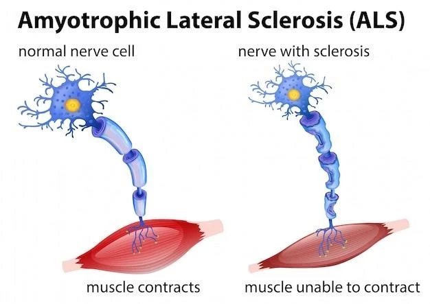 Understanding Myoclonus Hereditary Progressive Distal Muscular Atrophy