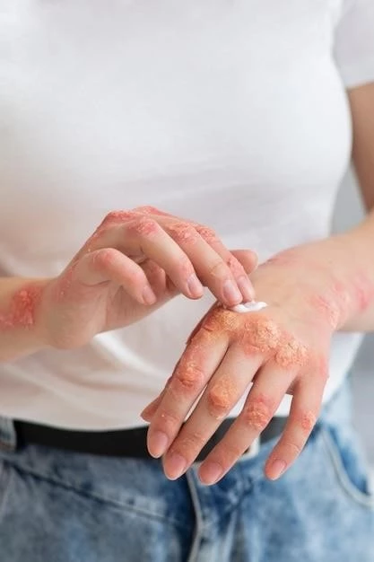 Understanding Cutaneous Lupus Erythematosus: Symptoms, Causes, Treatment, and Lifestyle Management