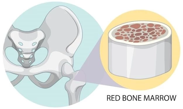 Overview of Osteosclerose Type Stanescu