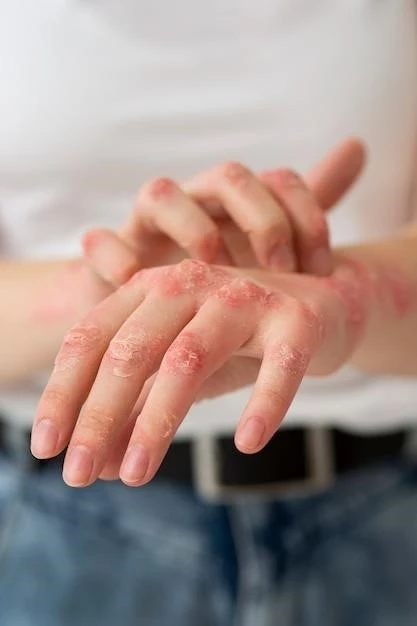 Understanding Psoriasis: Types, Symptoms, Causes, Diagnosis, and Treatment